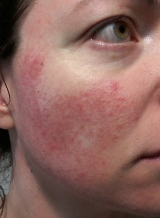 Rosacea on cheek - 1