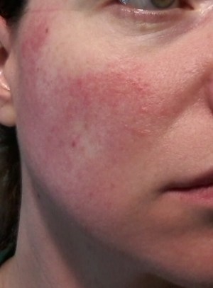 Cheek 1 -June 1, 2015 rosacea symptoms