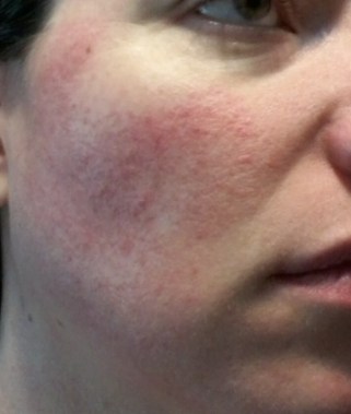 cheek 1 - June 2 2015 rosacea symptoms flush