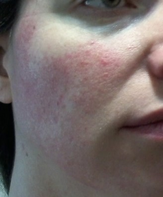 Cheek 1 - June 3 - Rosacea skin care