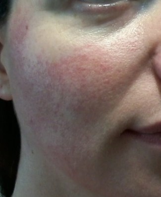 Cheek 1 - June 4 - rosacea skincare
