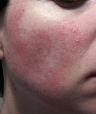 Cheek 1 - May 31 rosacea pictures