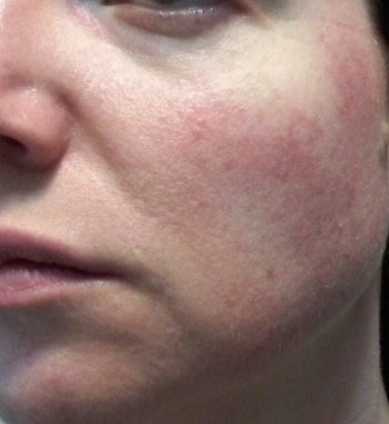 Cheek 1 -June 1, 2015 rosacea symptoms Cheek 2 -June 1, 2015 rosacea symptoms