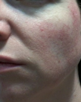 Cheek 2 - June 3 - Rosacea skin care