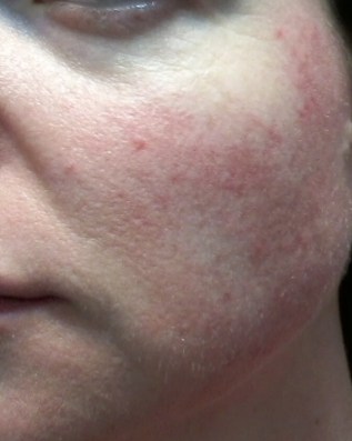 Cheek 2 - June 4 - rosacea skincare