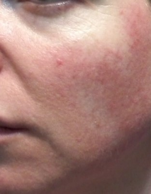 Cheek 2 - June 5 - control rosacea flushing treatment Cheek 2 - June 5 - control rosacea flushing treatment
