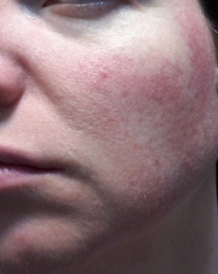 Cheek 2 - May 31 rosacea pictures