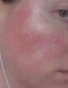 cheek 1 - Non-Laser LED Red Light Therapy natural rosacea treatment - July 19 2015