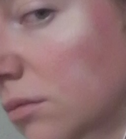 cheek 2 - Non-Laser LED Red Light Therapy natural rosacea treatment - July 19 2015