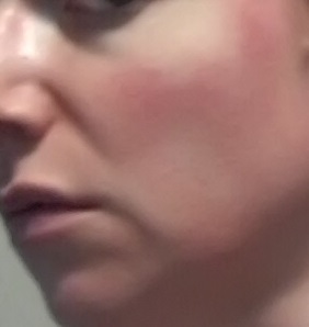 Cheek 2 - rosacea symptoms July 7 2015