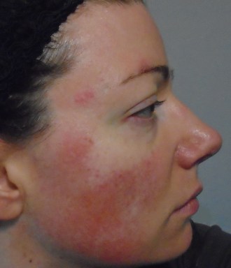 Alon Labs Rewind Acne Rosacea Flush