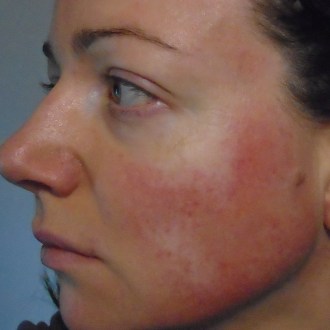 Alon Labs Rewind Acne Rosacea Flush2