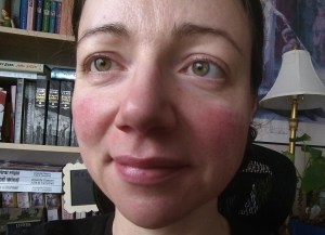 Rosy Cheeks from Rosacea 