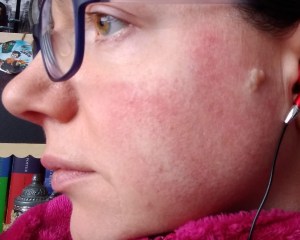 Bedrock Balm as Natural Skin Care for Rosacea Day 1