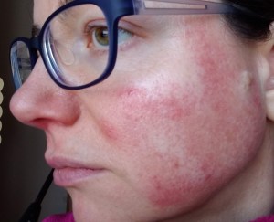 Flare-Up Before Picture